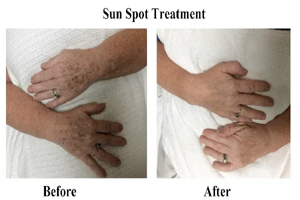 Sunspot Treatment: Effective Ways to Combat Summer Discoloration
